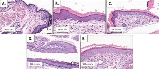 Basaloid Anal Transition Zone Tumor