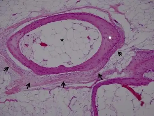 Benign Adipose Soft Tissue Tumors