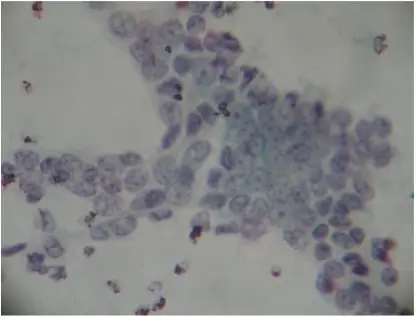 Benign Epithelial Lesions of the Breast