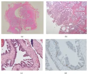 Benign Epithelial Tumors