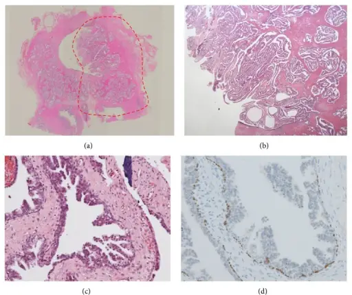 Benign Epithelial Tumors