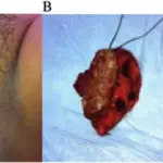 Benign Exophytic Lesions of the Vulva