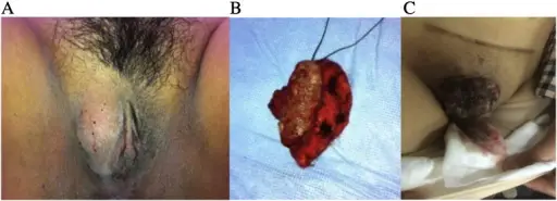 Benign Exophytic Lesions of the Vulva