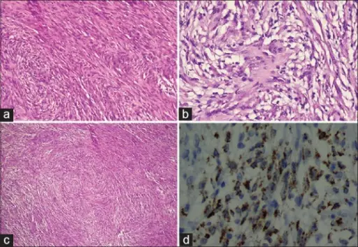 Benign Fibrous Soft Tissue Tumors