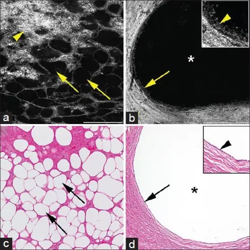 Benign Kidney Neoplasms