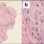 Benign Nerve Sheath Soft Tissue Tumors