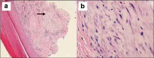 Benign Nerve Sheath Soft Tissue Tumors