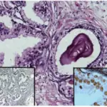 Benign Prostatic Hyperplasia