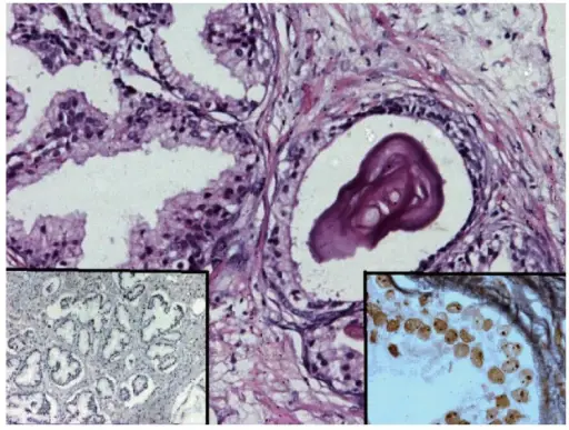 Benign Prostatic Hyperplasia