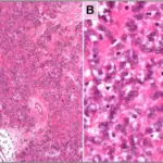 Benign Smooth Muscle Tumors