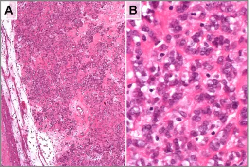 Benign Smooth Muscle Tumors