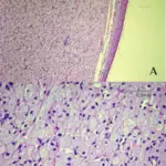 Benign Soft Tissue Tumors of Uncertain Origin