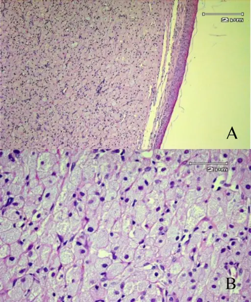 Benign Soft Tissue Tumors of Uncertain Origin