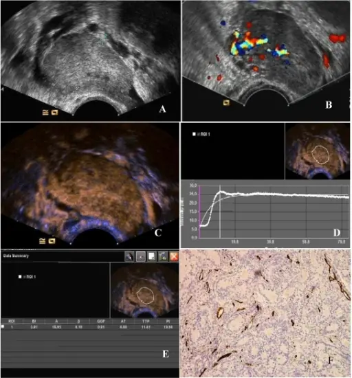 Benign Tumors and Tumor-Like Lesions of the Vasculature