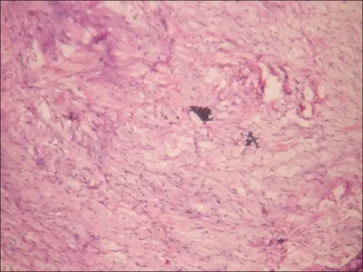 Benign Tumors of Odontogenic Epithelium and Ectomesenchyme