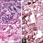 Benign Vascular Soft Tissue Tumors