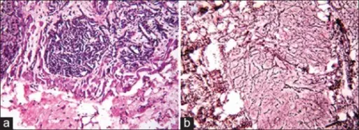 Benign Vascular Soft Tissue Tumors