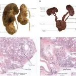 Bifid ureters