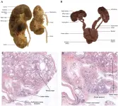 Bifid ureters