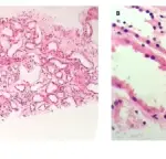 Bile Cast Nephropathy