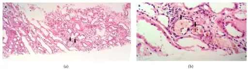 Bile Cast Nephropathy