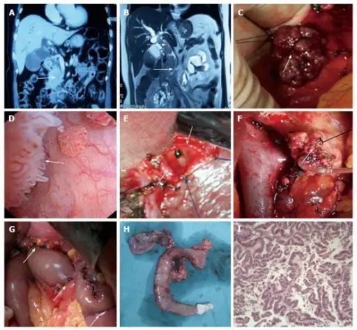 Bile Duct Obstruction