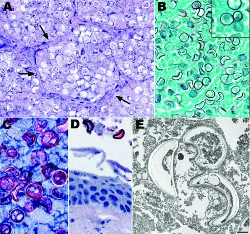 Blastomyces Fungal Infection