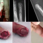 Blunt Force Injuries