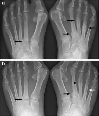 Bone Fractures