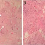 Borderline Tumors of the Vasculature