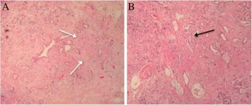 Borderline Tumors of the Vasculature