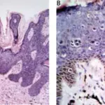 Bowenoid Papulosis of the Penis