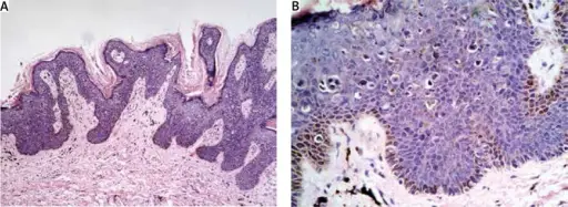 Bowenoid Papulosis of the Penis