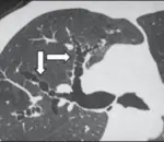 Bronchiectasis