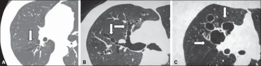 Bronchiectasis