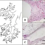 Bronchiolitis