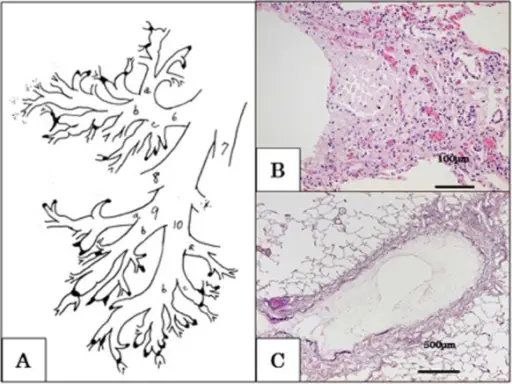 Bronchiolitis