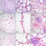 Bronchopulmonary Dysplasia