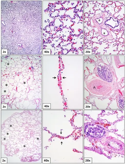 Bronchopulmonary Dysplasia