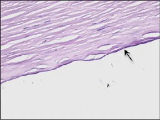 Bullous keratopathy and stromal edema Aka Fuchs Endothelial Dystrophy