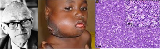 Burkitt Lymphoma