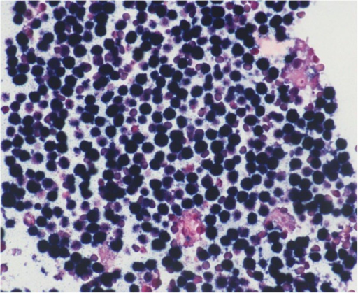 Burkitt Lymphoma