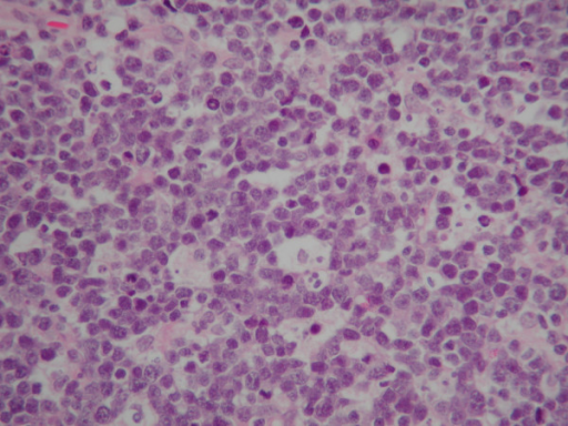 Burkitt Lymphoma