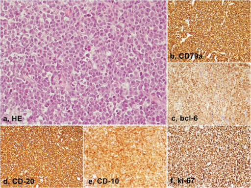 Burkitt Lymphoma