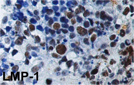 Burkitt Lymphoma