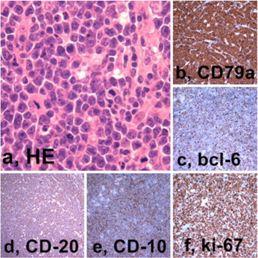 Burkitt Lymphoma