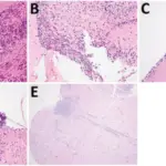 CENTRAL NERVOUS SYSTEM PATHOLOGY