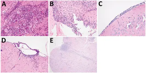 CENTRAL NERVOUS SYSTEM PATHOLOGY