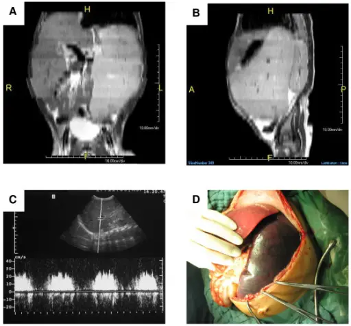 CONGESTIVE SPLENOMEGALY