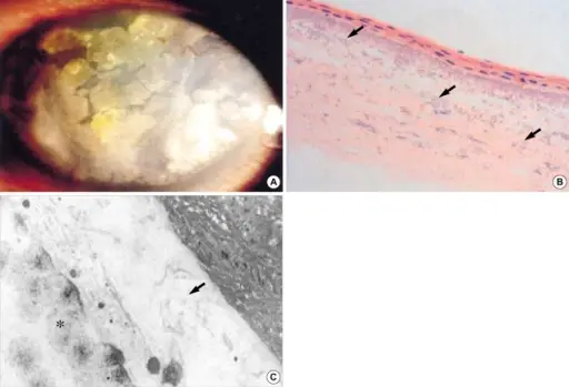 Calcific Band Keratopathy